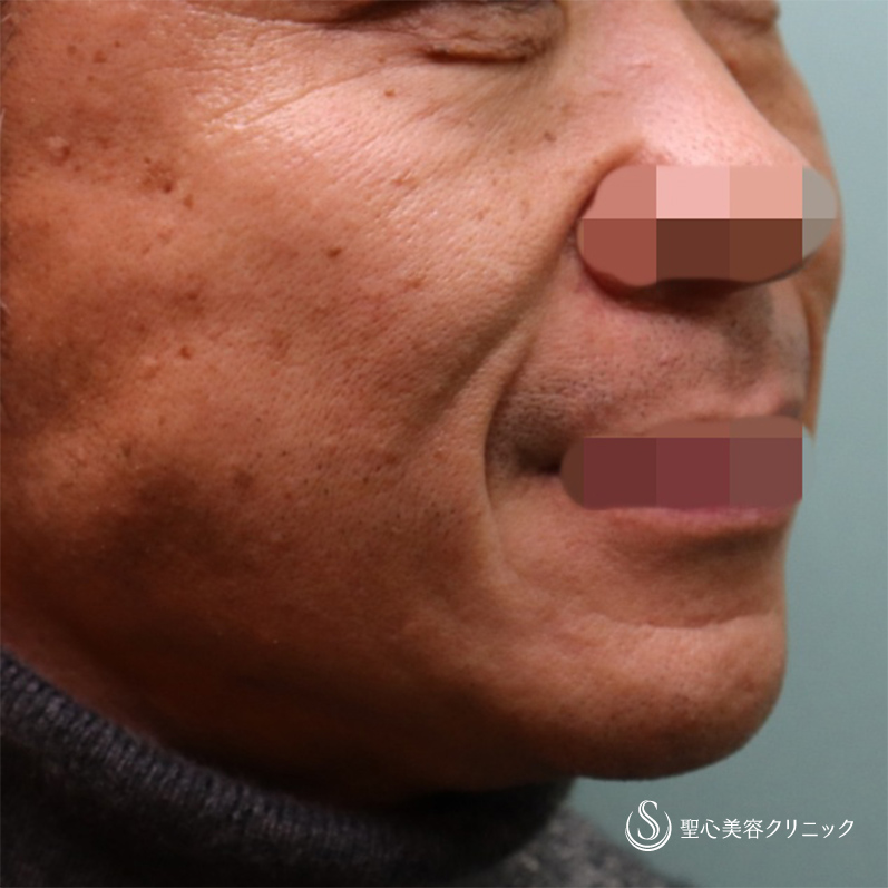 【50代男性・目の下とほうれい線】プレミアムPRP皮膚再生療法（6ヶ月後） Before 