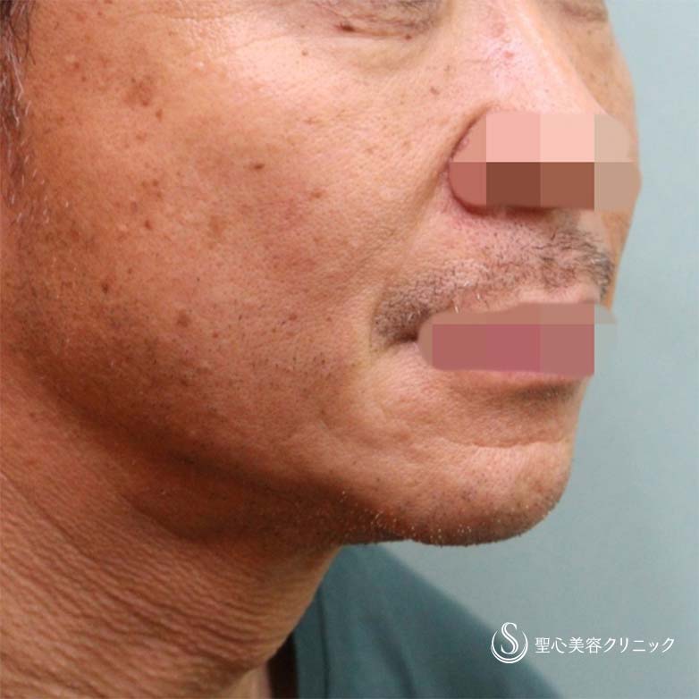 【50代男性・目の下とほうれい線】プレミアムPRP皮膚再生療法（6ヶ月後） After 