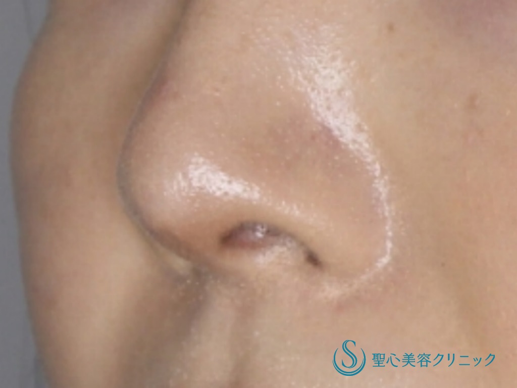 【30代女性・鼻の穴を目立ちにくく】鼻孔縁下降術（3か月後） After 