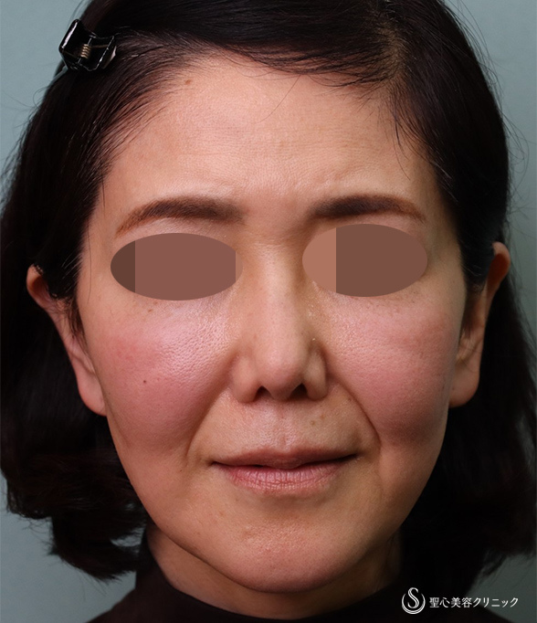 【50代女性・ほうれい線】プレミアムPRP皮膚再生療法（術後3カ月） Before 