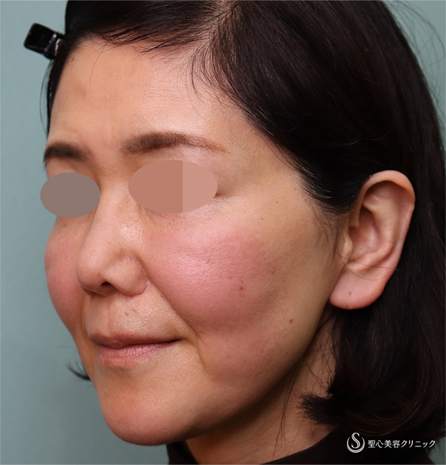 【50代女性・ほうれい線】プレミアムPRP皮膚再生療法（術後3カ月） Before 