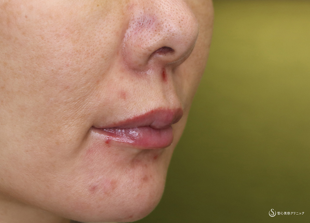 【50代女性・鼻下を短く】鼻下短縮術（リップリフト）（6か月後） Before 