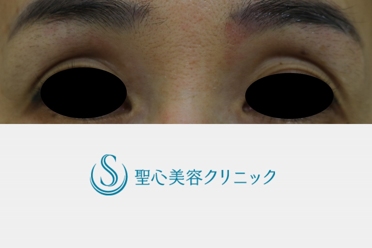【50代女性・目の上のくぼみ】プレミアムPRP皮膚再生療法（目の上）（11か月後） Before 