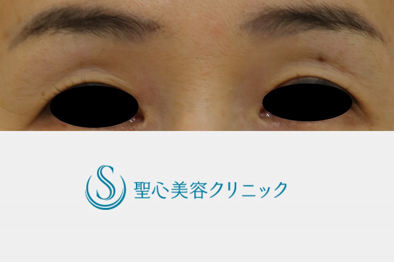 【50代女性・目の上のくぼみ】プレミアムPRP皮膚再生療法（目の上）（11か月後） After 