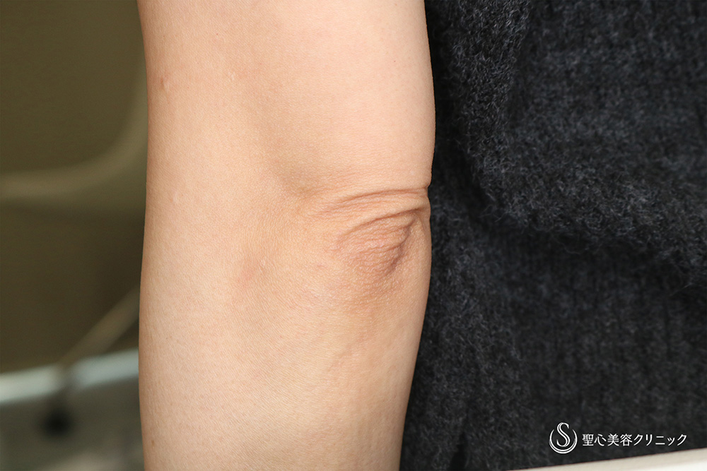 【50代女性・肘のシワ】プレミアムPRP皮膚再生療法（術後6カ月）　 Before 