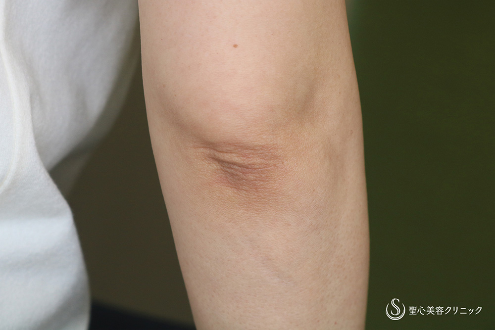 【50代女性・肘のシワ】プレミアムPRP皮膚再生療法（術後6カ月）　 After 