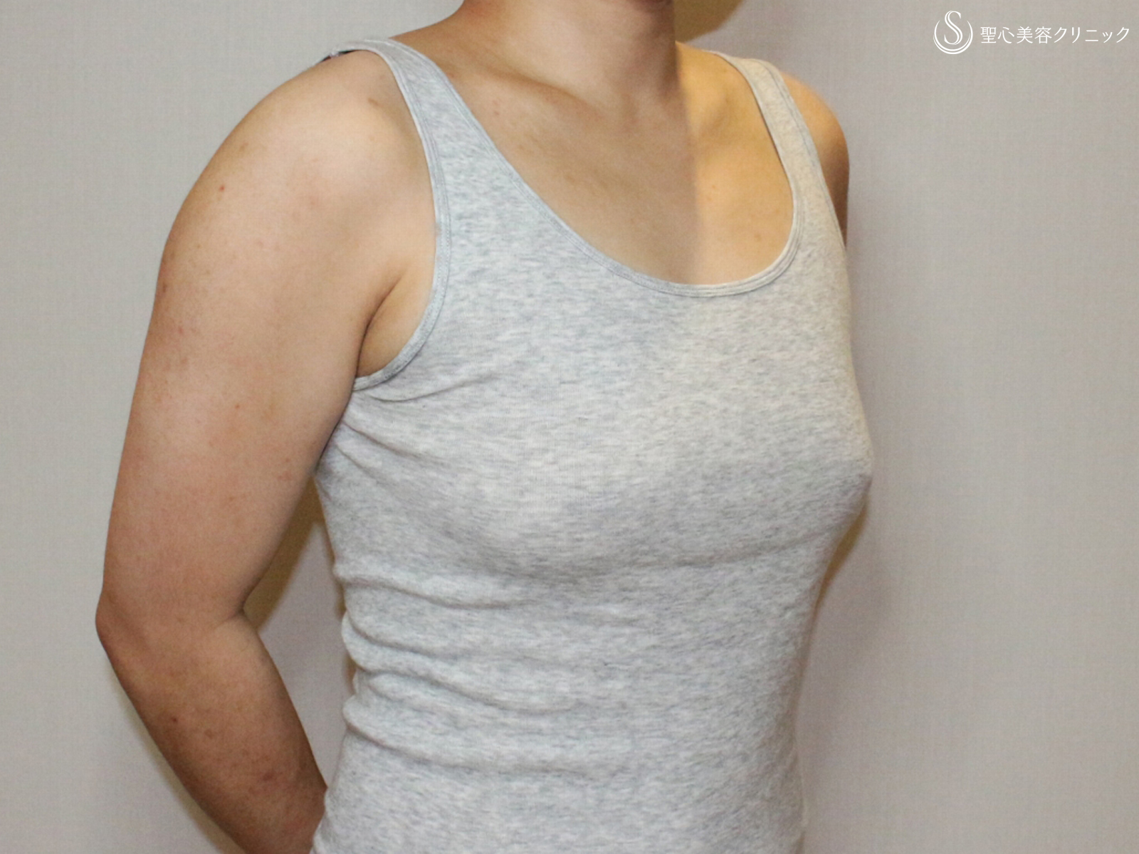 【20代女性・性同一性障害（FTM）男らしい胸に】乳腺切除術+脂肪吸引（1ヶ月後） Before 