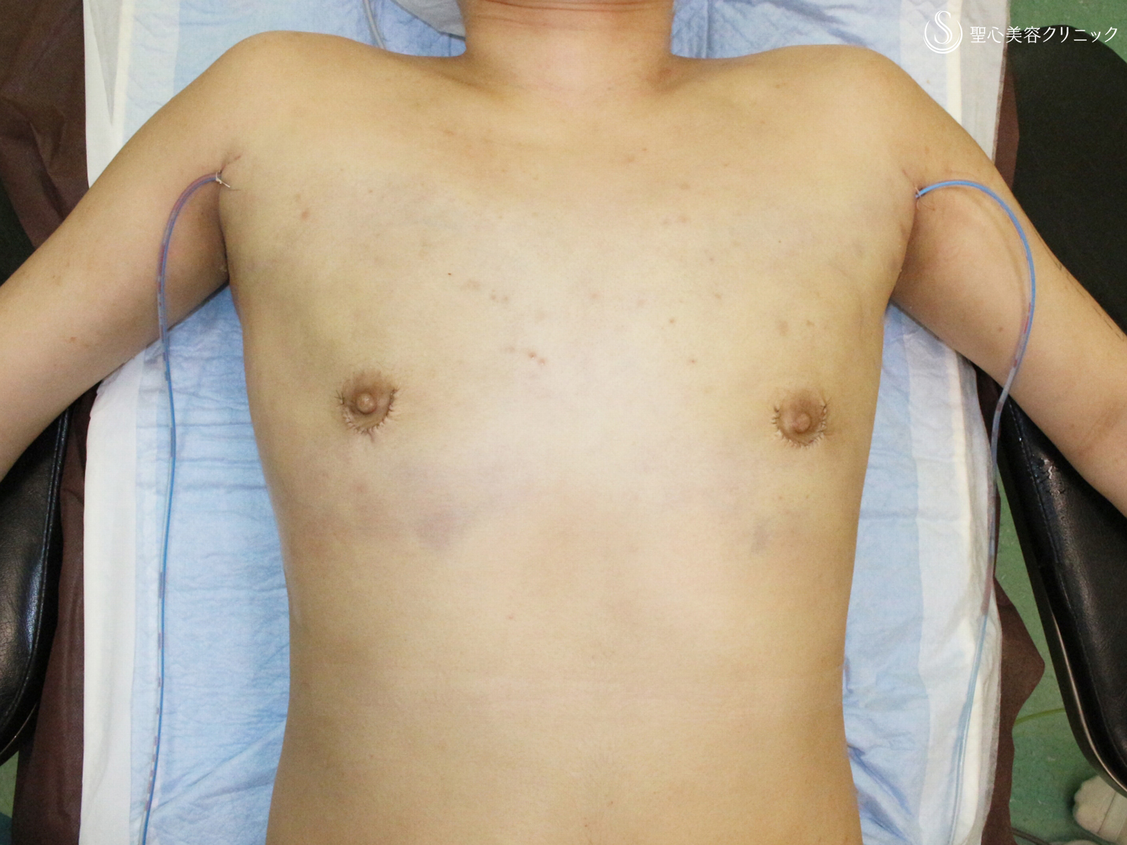 【20代女性・性同一性障害（FTM）男らしい胸に】乳腺切除術+脂肪吸引（1ヶ月後） After 