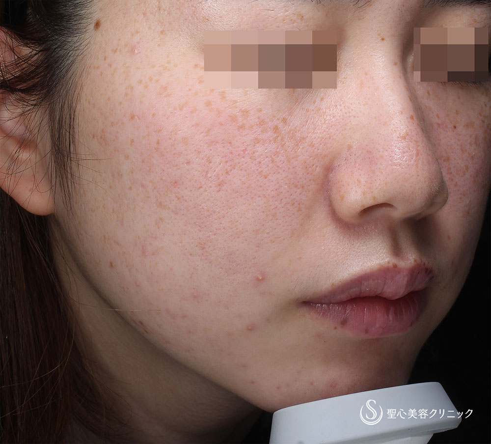 20代女性・そばかす】PICOレーザー（術後3カ月） - 症例写真 - 美容