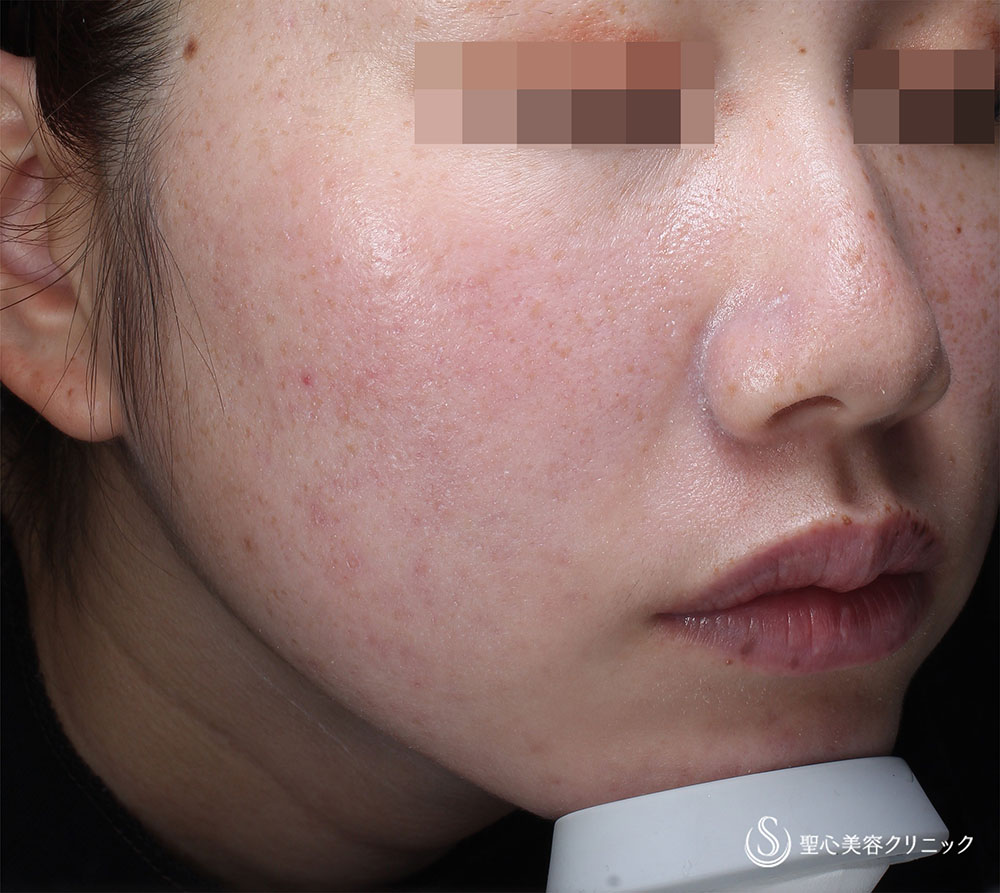 【20代女性・そばかす】PICOレーザー（術後3カ月） After 