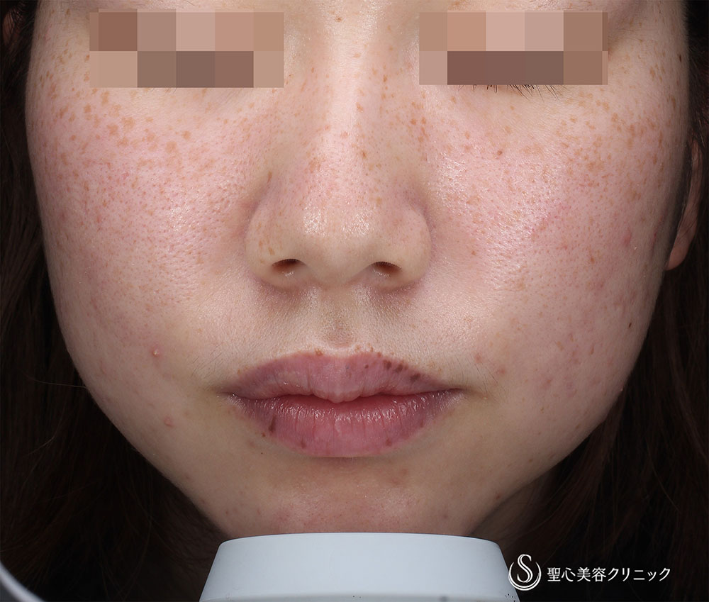 【20代女性・そばかす】PICOレーザー（術後3カ月） Before 