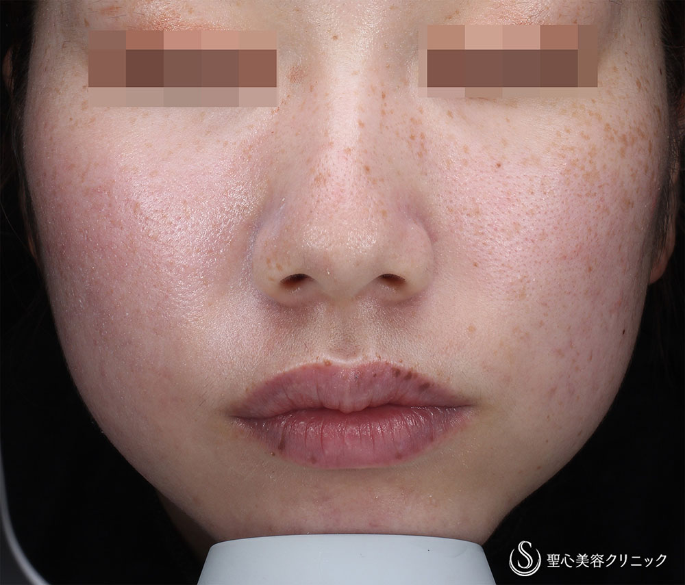 【20代女性・そばかす】PICOレーザー（術後3カ月） After 