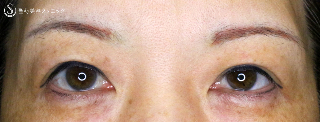 【50代女性・整形ではなく若返り治療】眉下リフト+α単独（8年後） After 