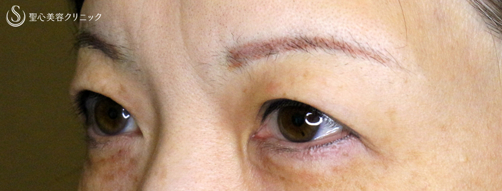 【50代女性・整形ではなく若返り治療】眉下リフト+α単独（8年後） After 