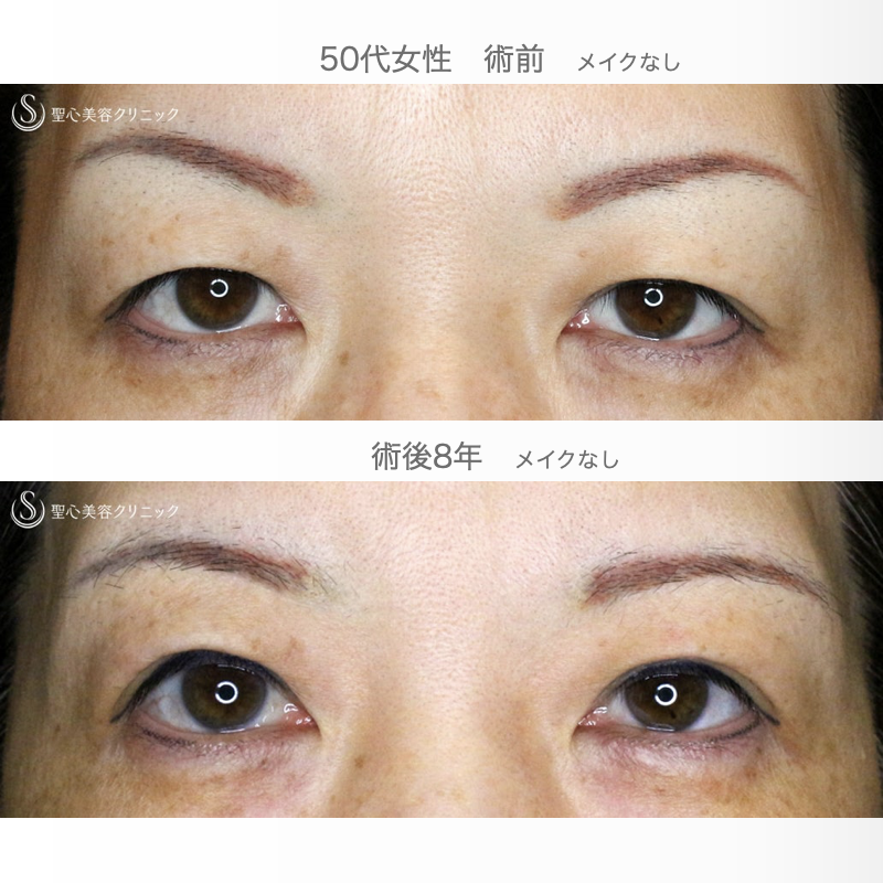 【50代女性・整形ではなく若返り治療】眉下リフト+α単独（8年後） After 