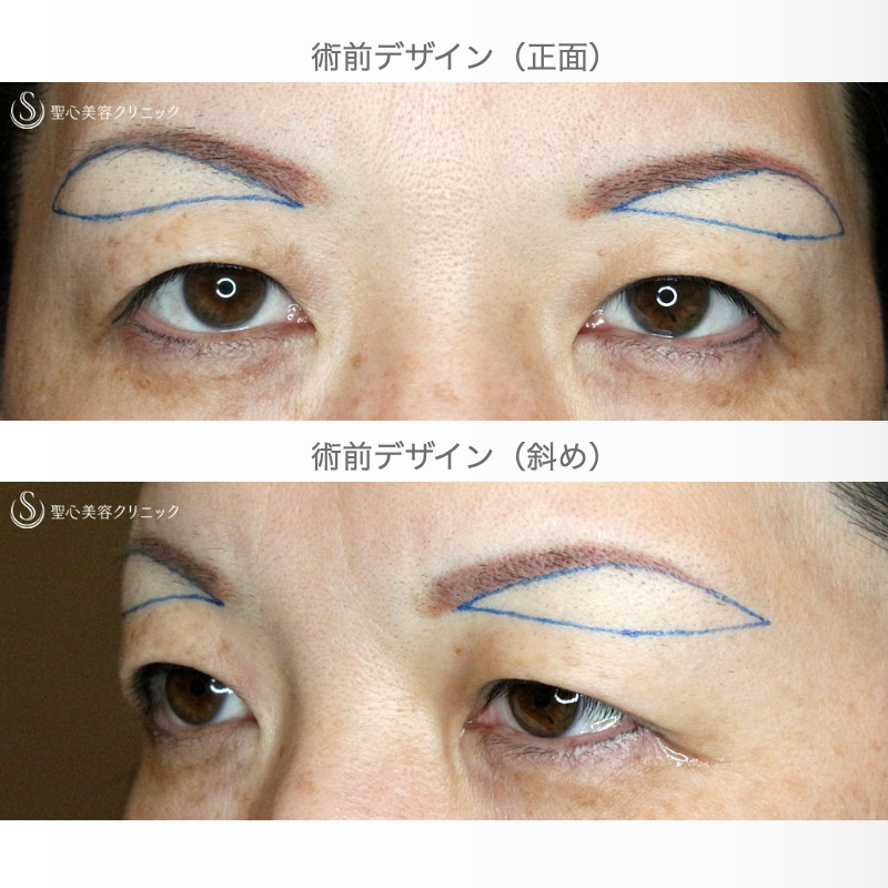 【50代女性・整形ではなく若返り治療】眉下リフト+α単独（8年後） Before 