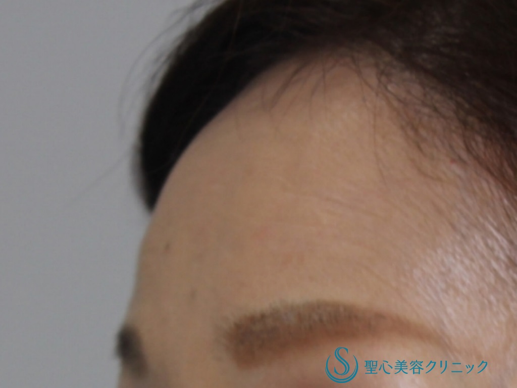 【60代女性・額、眉間をふっくらと若々しく】プレミアムPRP皮膚再生療法（術後2カ月後） Before 