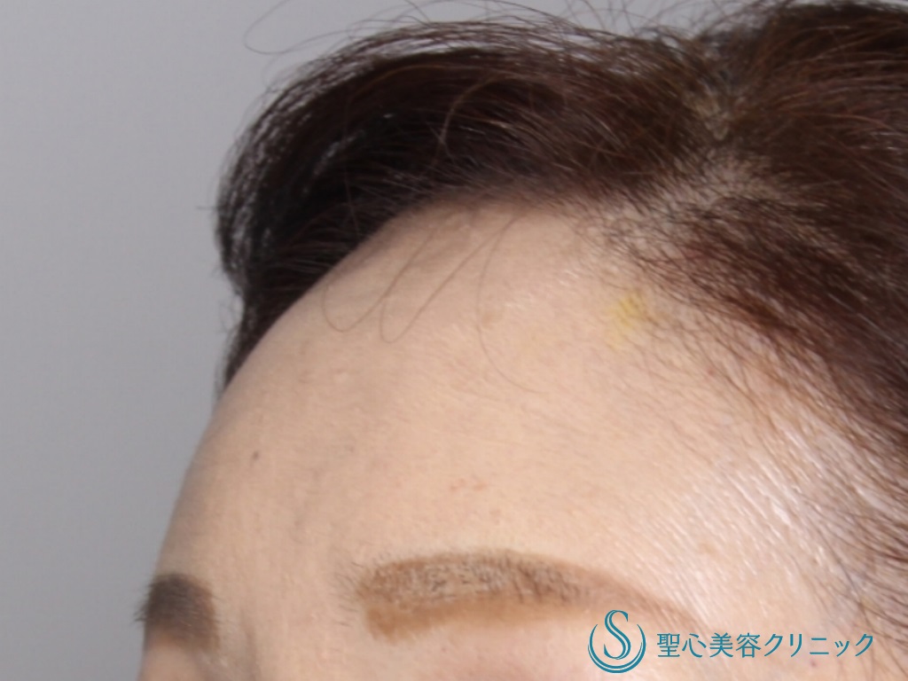 【60代女性・額、眉間をふっくらと若々しく】プレミアムPRP皮膚再生療法（術後2カ月後） After 