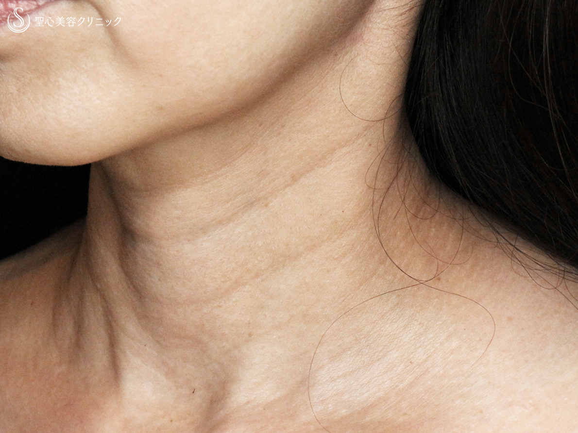 【50代女性・首の横ジワの注入治療】プレミアムPRP皮膚再生療法（2年後） Before 