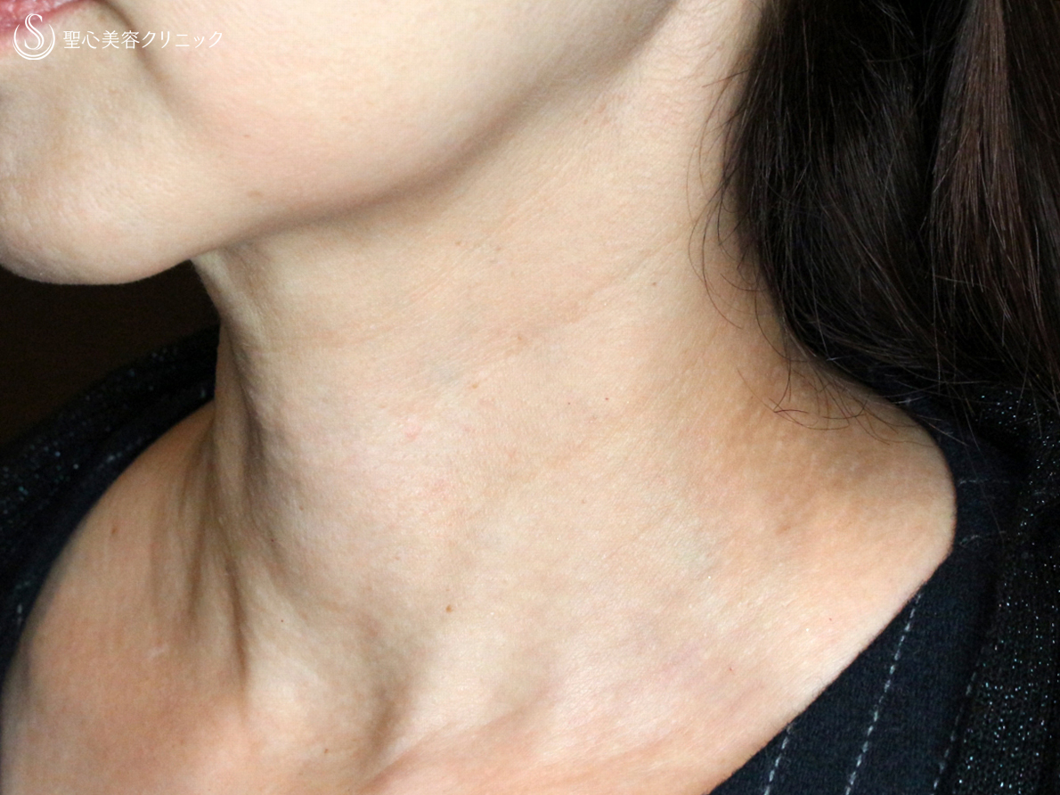 【50代女性・首の横ジワの注入治療】プレミアムPRP皮膚再生療法（2年後） After 