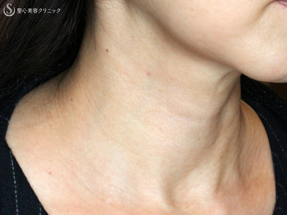 【50代女性・首の横ジワの注入治療】プレミアムPRP皮膚再生療法（2年後） After 