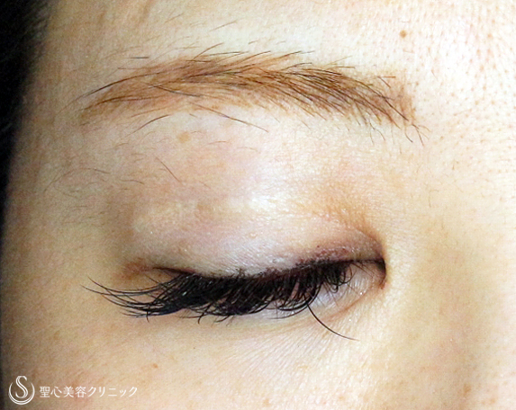 【20代女性・他院全切開後の修正】眼瞼下垂手術を応用した全切開法（8年後） After 