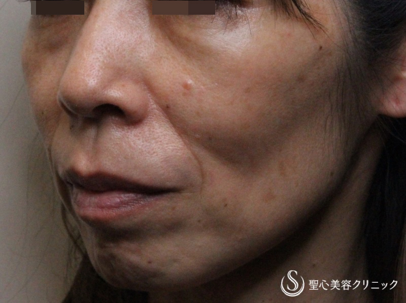 【50代女性・中下顔面の凹み】プレミアムPRP皮膚再生療法（術後2年） Before 