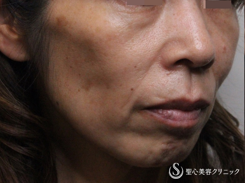 【50代女性・中下顔面の凹み】プレミアムPRP皮膚再生療法（術後2年） Before 