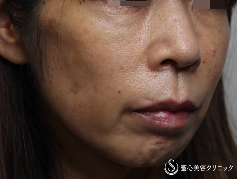 【50代女性・中下顔面の凹み】プレミアムPRP皮膚再生療法（術後2年） After 