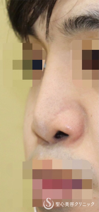 【30代男性・お鼻をしっかり修正】3Dオーダープロテーゼ・鼻中隔延長・鼻尖形成（術後2ヶ月） Before 