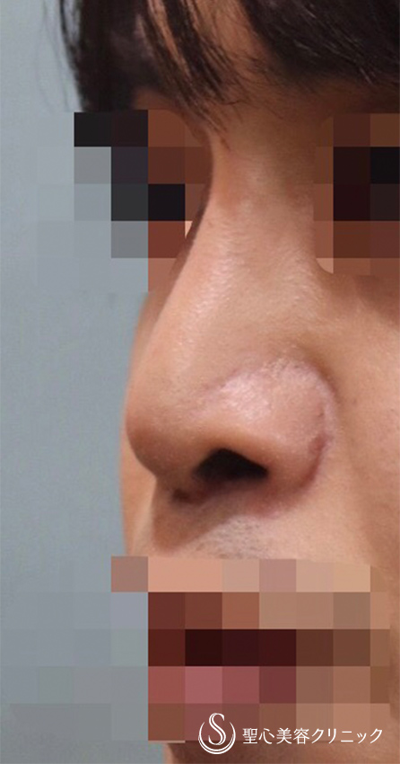 【30代男性・お鼻をしっかり修正】3Dオーダープロテーゼ・鼻中隔延長・鼻尖形成（術後2ヶ月） After 