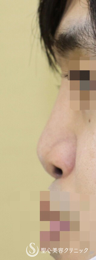 【30代男性・お鼻をしっかり修正】3Dオーダープロテーゼ・鼻中隔延長・鼻尖形成（術後2ヶ月） Before 