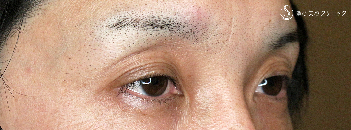 【30代男性・切らずに下垂と凹み目を改善】切らない眼瞼下垂+α法（2ヶ月後） Before 