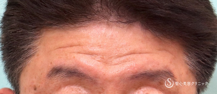 【50代男性・額のしわ】プレミアムPRP皮膚再生療法（2回施術後2カ月後） Before 