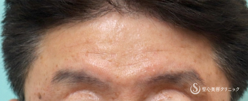 【50代男性・額のしわ】プレミアムPRP皮膚再生療法（2回施術後2カ月後） After 