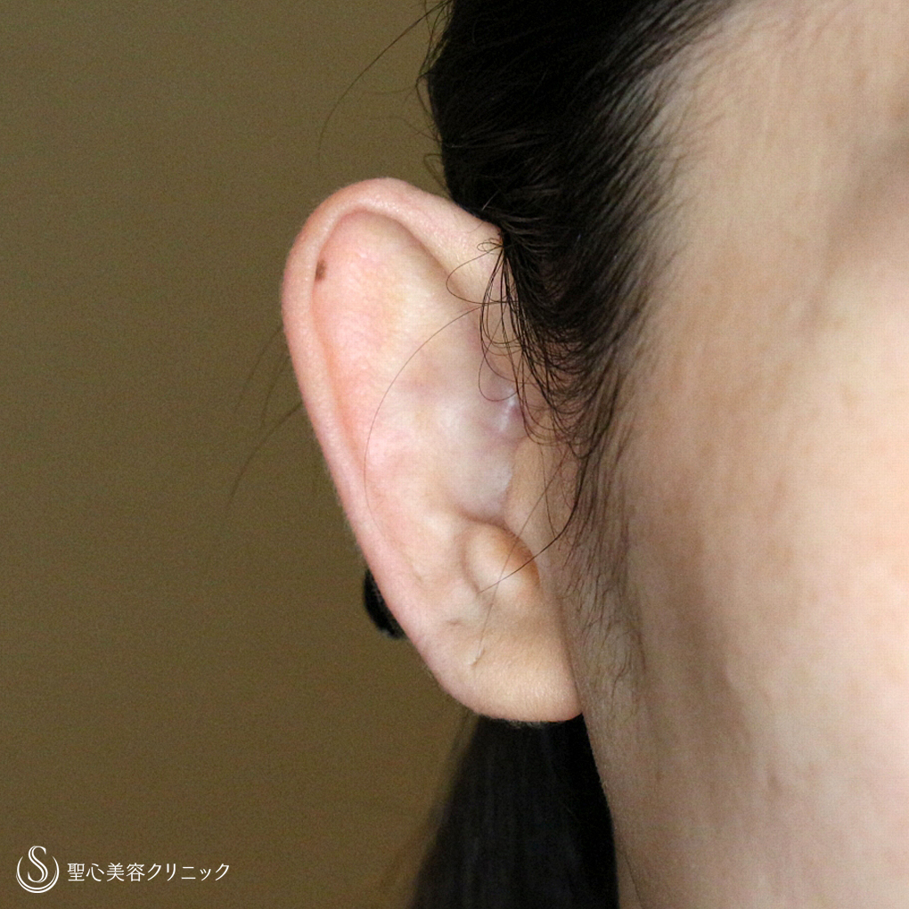 【30代女性・髪から耳が出なくなる】立ち耳の治療は「埋没法」（1年後） Before 