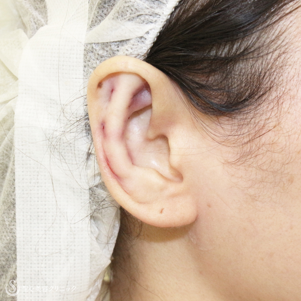 【30代女性・髪から耳が出なくなる】立ち耳の治療は「埋没法」（1年後） After 
