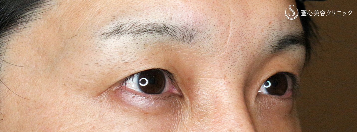 【30代男性・切らずに下垂と凹み目を改善】切らない眼瞼下垂+α法（2ヶ月後） After 