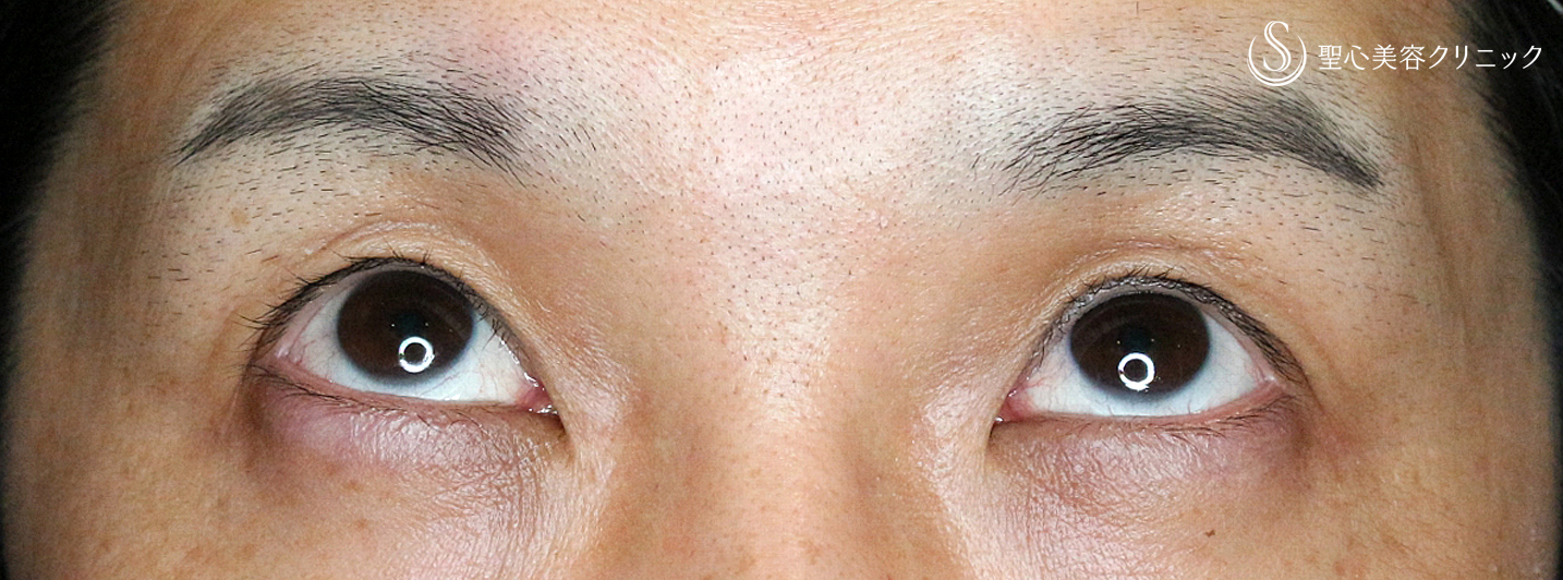 【30代男性・切らずに下垂と凹み目を改善】切らない眼瞼下垂+α法（2ヶ月後） After 