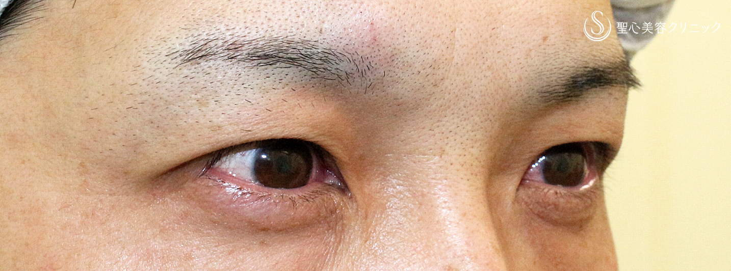 【30代男性・切らずに下垂と凹み目を改善】切らない眼瞼下垂+α法（2ヶ月後） Before 