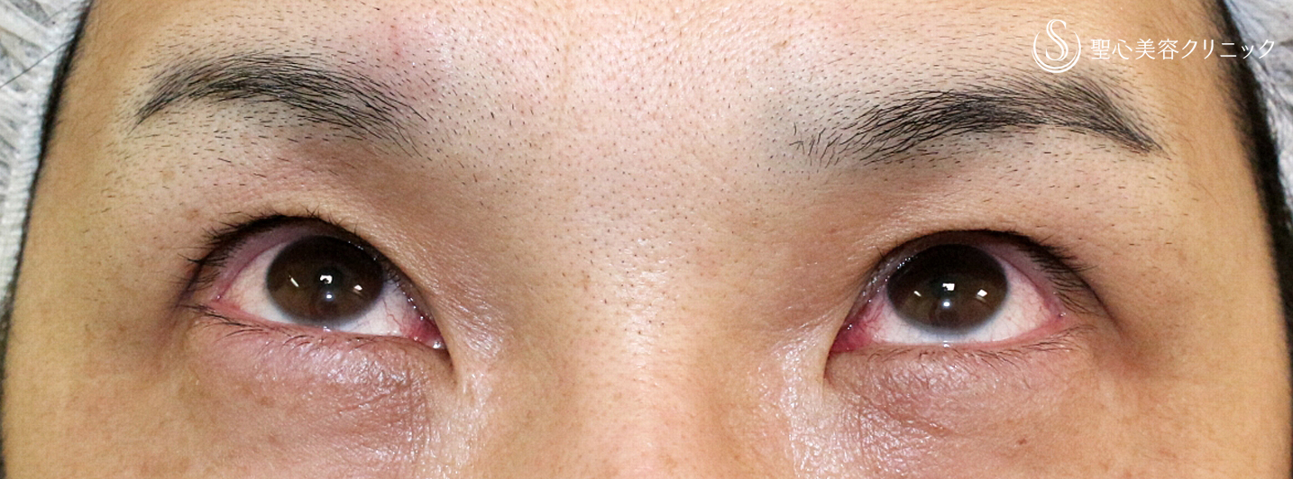 【30代男性・切らずに下垂と凹み目を改善】切らない眼瞼下垂+α法（2ヶ月後） Before 