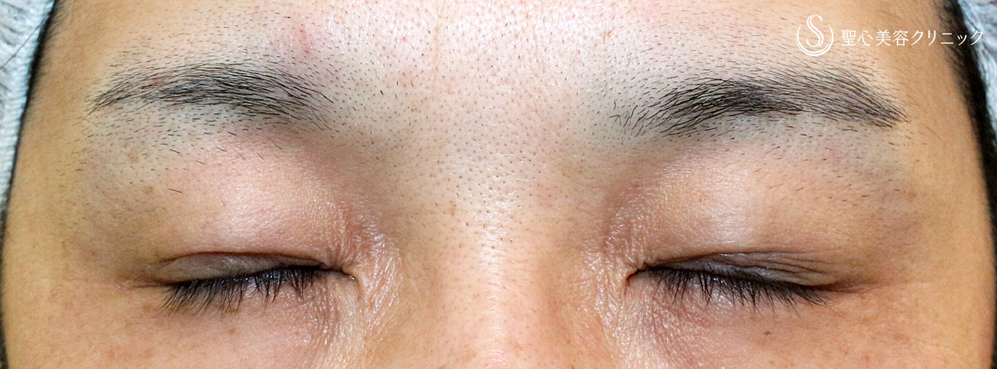 【30代男性・切らずに下垂と凹み目を改善】切らない眼瞼下垂+α法（2ヶ月後） After 