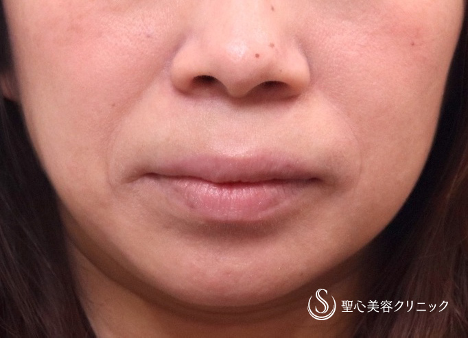 【30代女性・ほうれい線】プレミアムPRP皮膚再生療法（術後5カ月） Before 