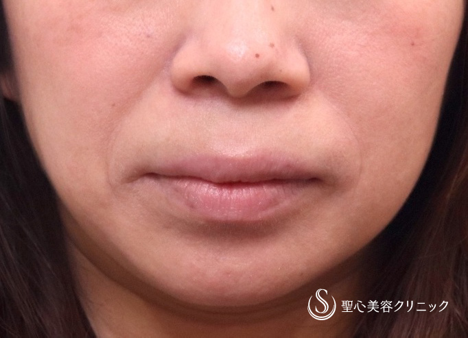 【30代女性・ほうれい線】プレミアムPRP皮膚再生療法（術後5カ月） Before 