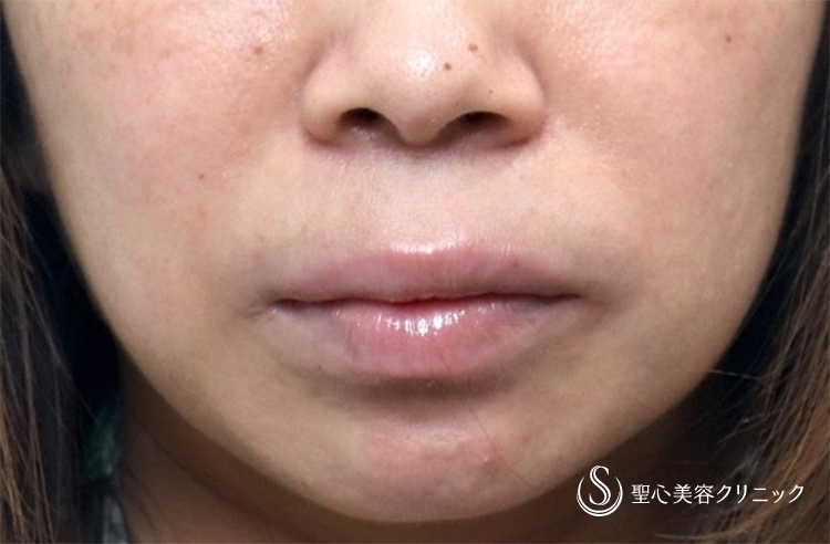 【30代女性・ほうれい線】プレミアムPRP皮膚再生療法（術後5カ月） After 