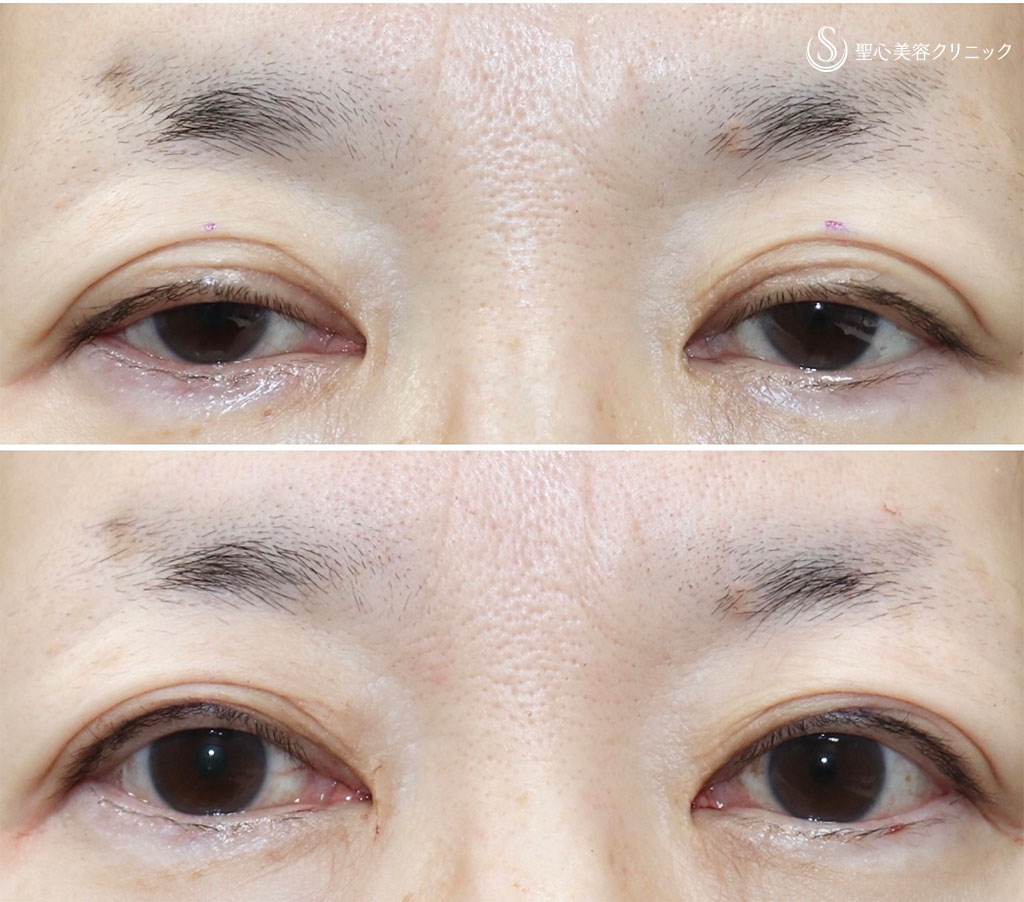 【50代女性・切らない眼瞼下垂で目の開きずらさを解消】眼瞼下垂（埋没法）（術直後） After 