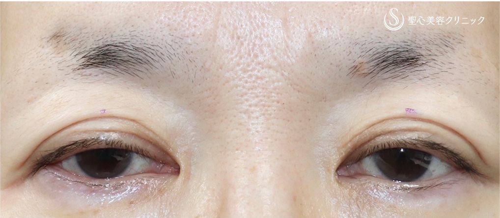 【50代女性・切らない眼瞼下垂で目の開きずらさを解消】眼瞼下垂（埋没法）（術直後） Before 
