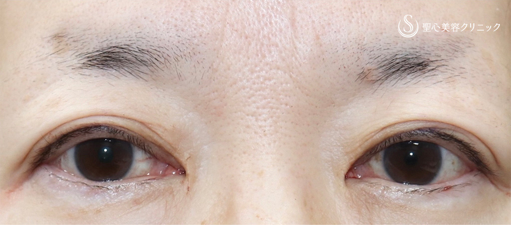 【50代女性・切らない眼瞼下垂で目の開きずらさを解消】眼瞼下垂（埋没法）（術直後） After 
