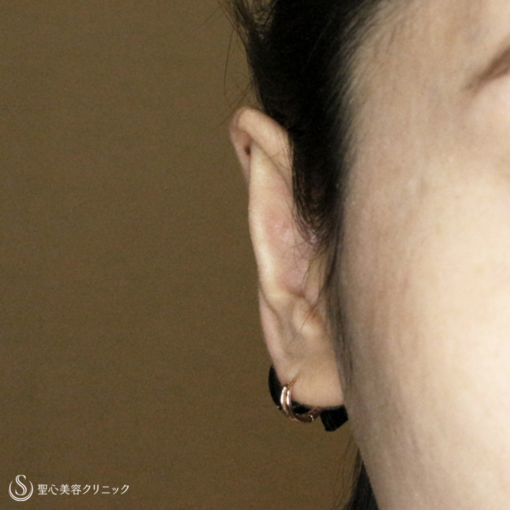 【30代女性・髪から耳が出なくなる】立ち耳の治療は「埋没法」（1年後） After 
