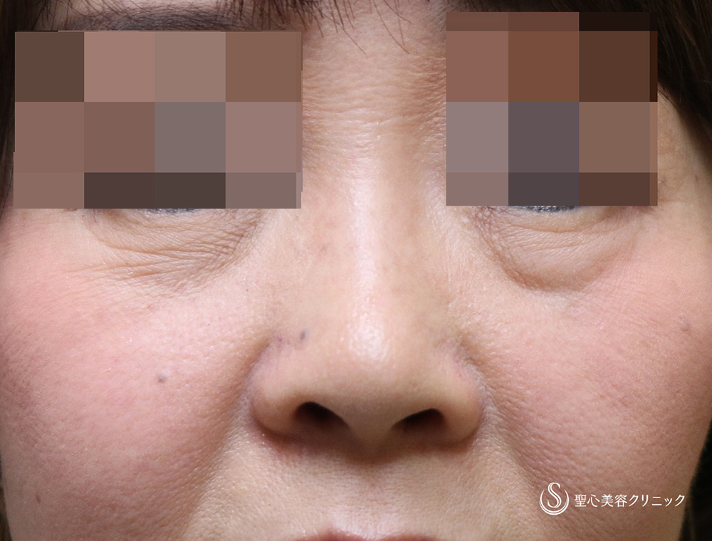 【50代女性・目の下のたるみ】プレミアムPRP皮膚再生療法長期経過（施術後3年） Before 